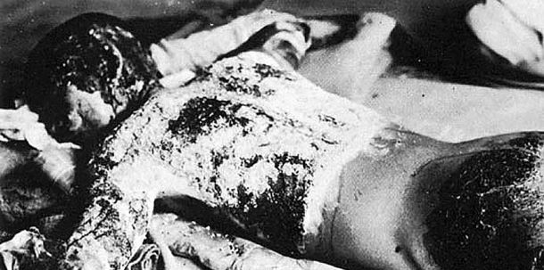 Ein Opfer der Bombe in Hiroshima (7. August 1945)