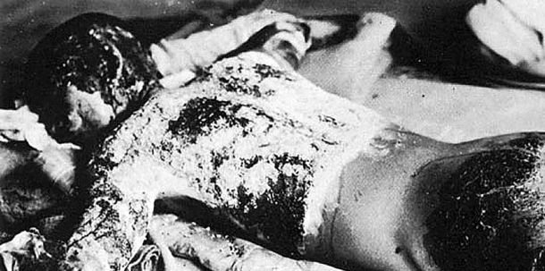 Ein Opfer der Bombe in Hiroshima (7. August 1945)